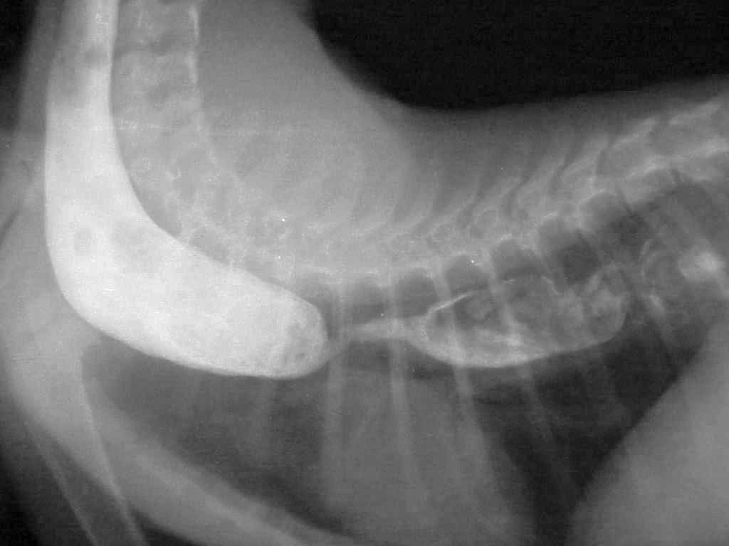 Negative contrast esophagram